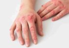 Don't take skin disorders for granted, new study