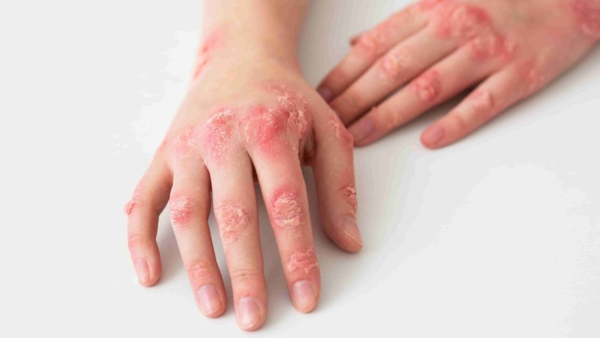 Don't take skin disorders for granted, new study